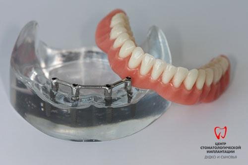 Балочные протезы отличный вариант протезирования зубов при полной адентии.