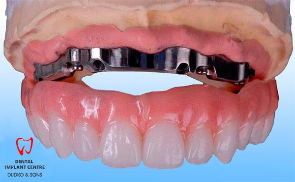 bar-retained removable prosthesis - Indications for installation