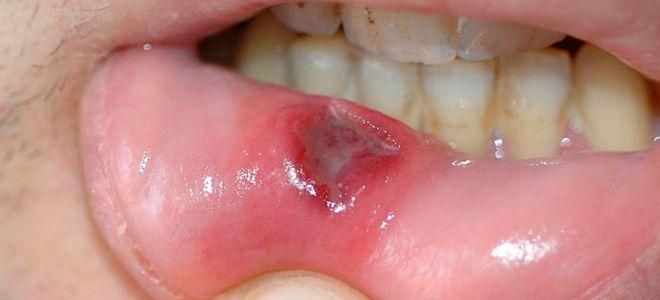 Stomatitis adult photos. Inflammation on the lower lip