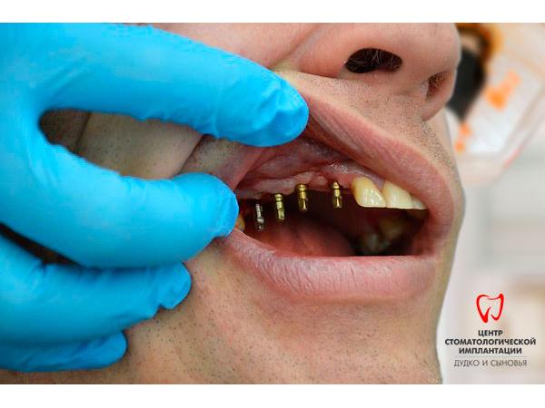 Базальная имплантация зубов Томск Глухой Импланты Nobel Biocare Томск Южный