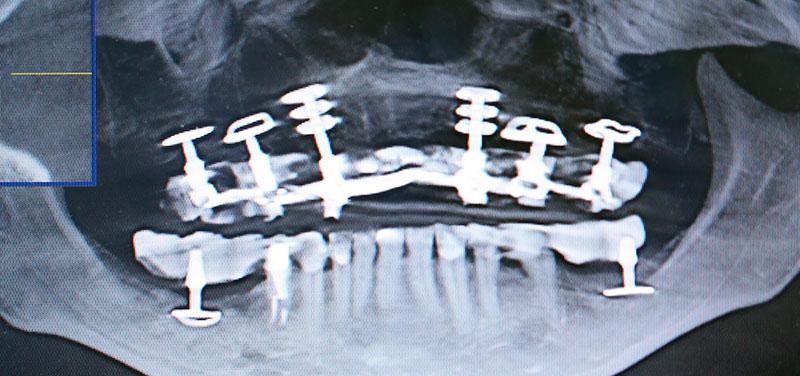 x-ray of the jaw after basal implantation