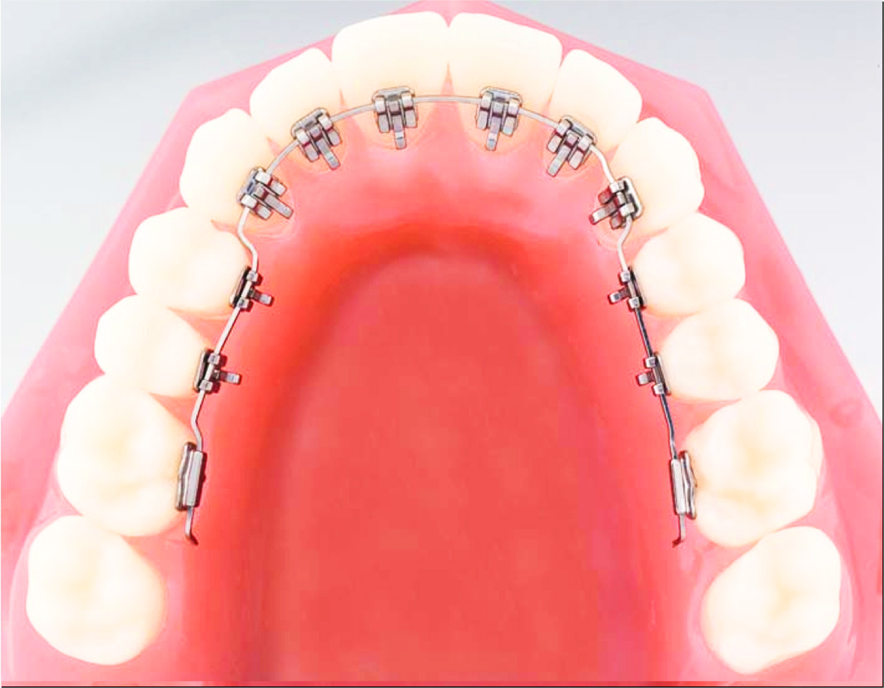 Linguale Zahnspangen