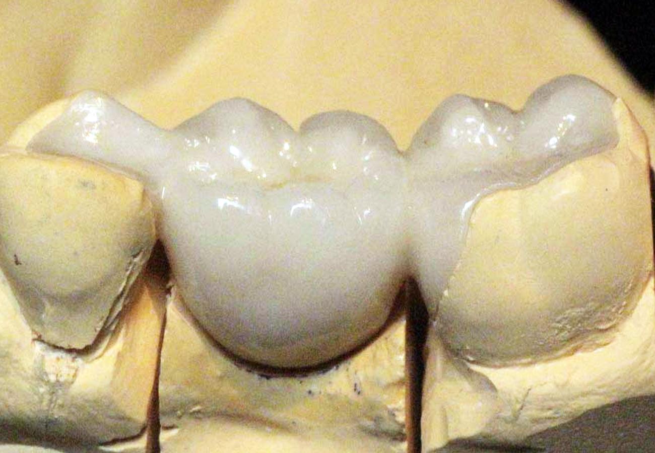 Die adhäsive Prothetik verwendet benachbarte Zähne als Grundlage für die Befestigung, sie werden jedoch nicht gedreht.