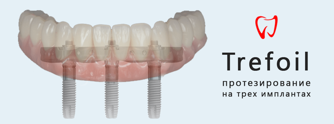 Протезирование зубов на трех имплантах при полной адентии