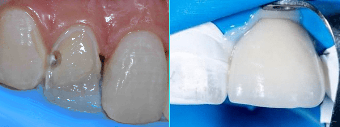 Tooth restoration process by applying a composite veneer