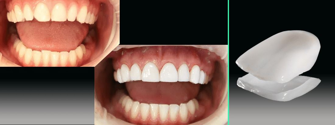 Restoration of teeth with E-Max Veneers