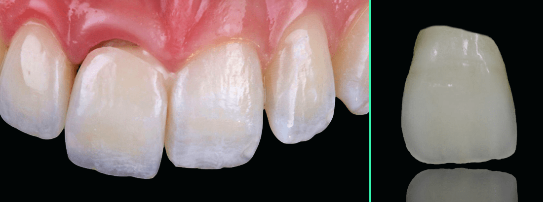 Restoration of teeth with porcelain veneers from press-ceramics