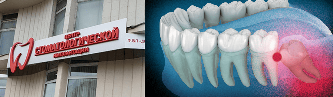 Extraction of a wisdom tooth in the Minsk clinic Dudko and sons