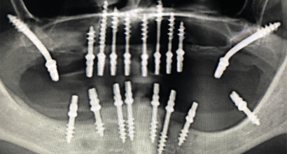 Базальные имплантаты на панорамном рентгеновском снимке