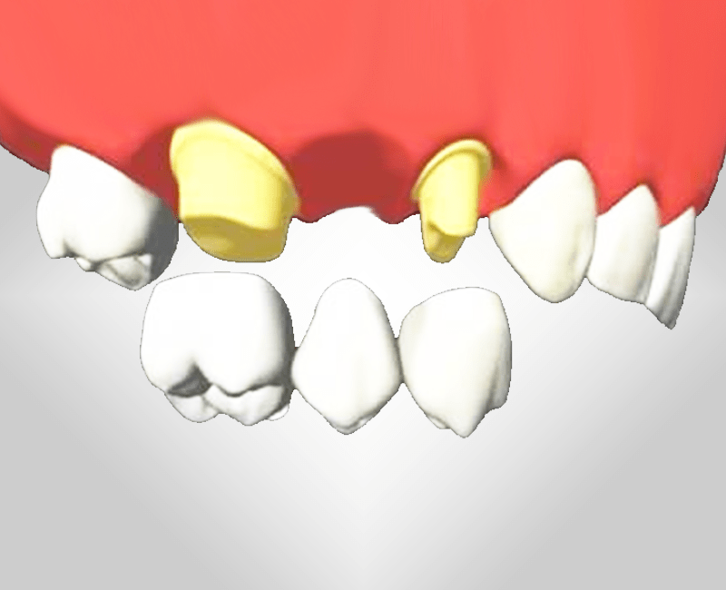 Зубные мосты