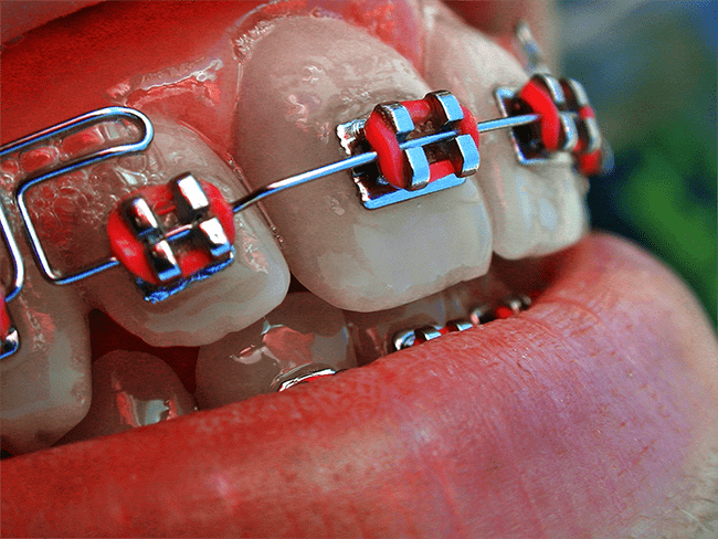 Брекеты на зубы в клинике