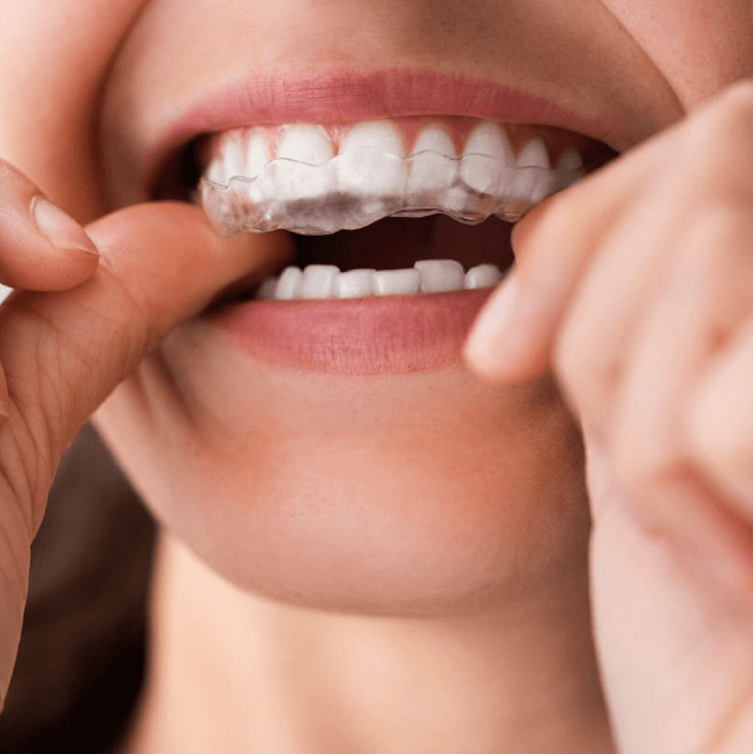 Alignery (alignery do prostowania zębów) wykonane w mińskiej stomatologii Dudko i Synowie