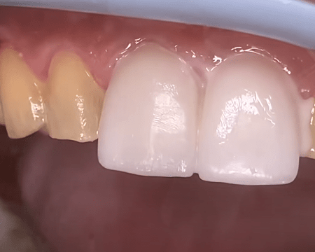 Установка керамического винира в стоматологии