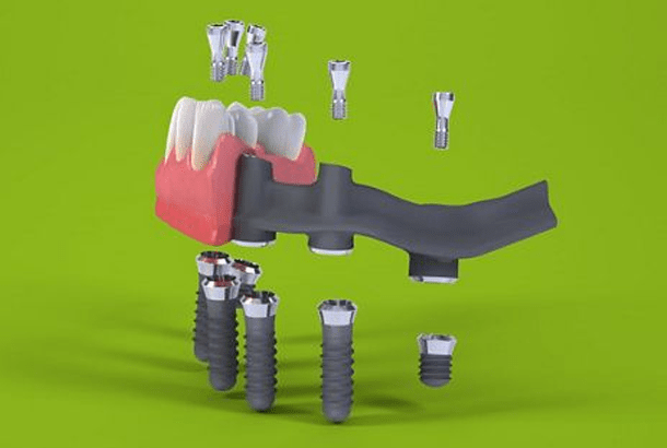 Fixed attachment of the prosthesis to the implants according to the protocol Straumann ProArch