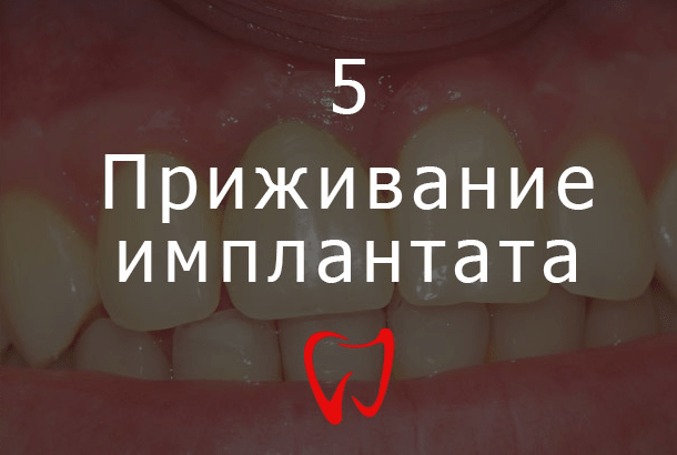 Пятый этап имплантации зубов - Приживание имплантата