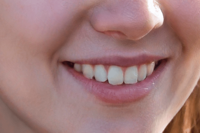 Teeth alignment in Minsk
