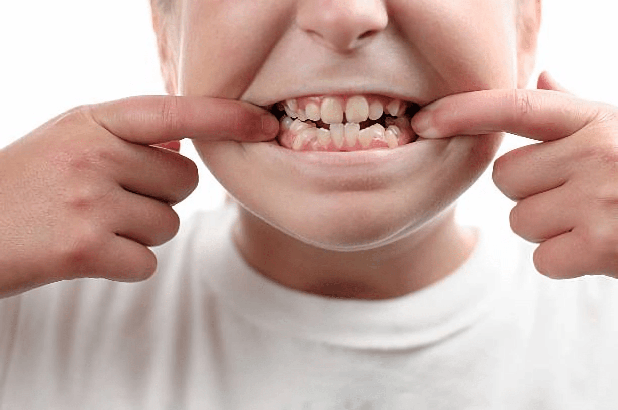 Krzywe zęby jako jeden z problemów, który rozwiązuje stomatologia estetyczna