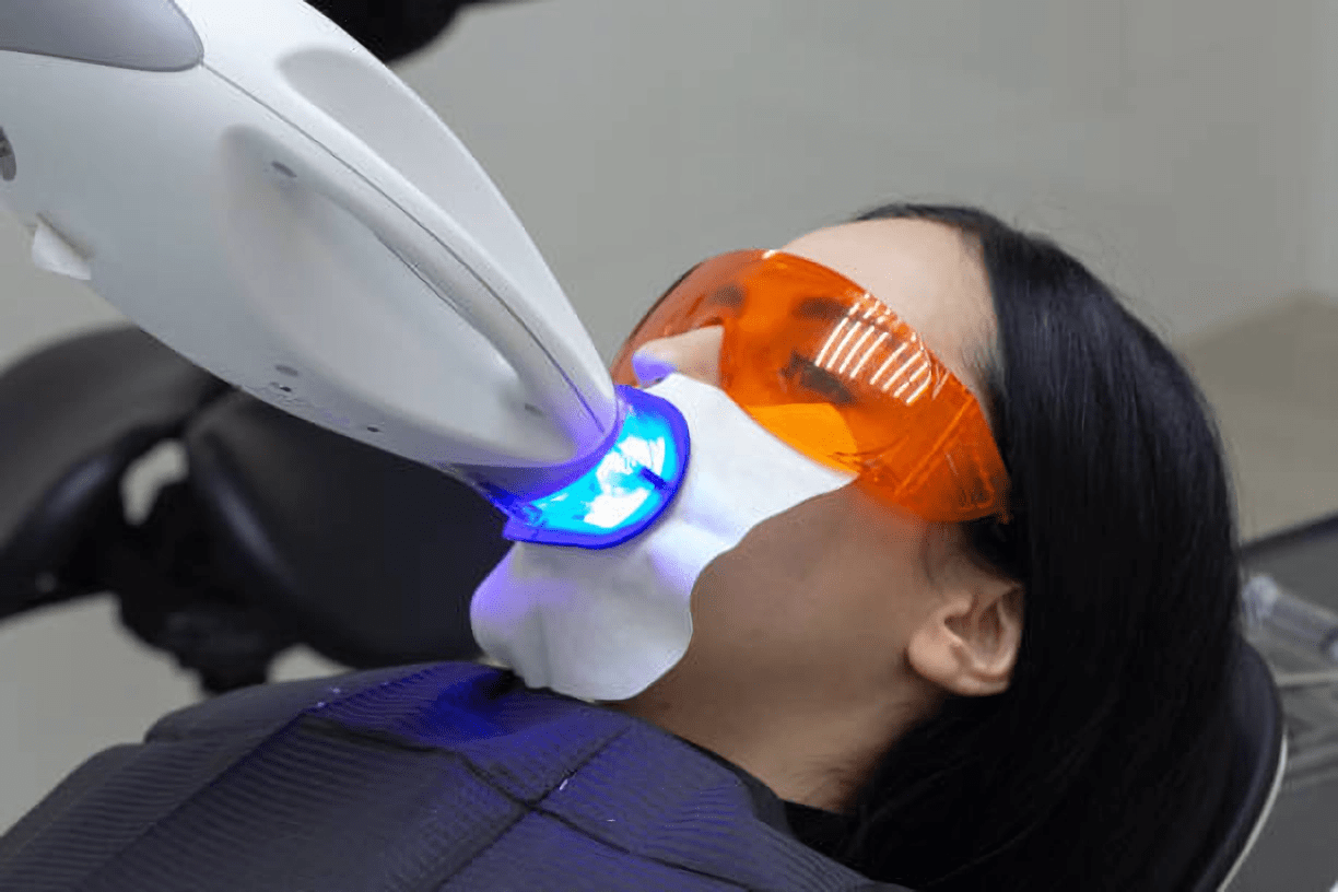Bleaching von Zähnen - eine Methode der ästhetischen Zahnmedizin