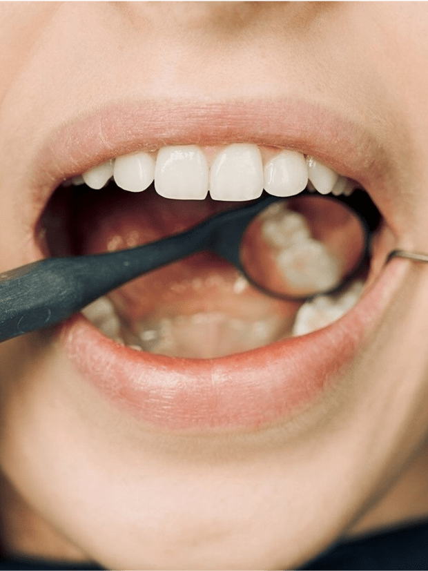 Иссечение десны при перикоронарите зуба мудрости